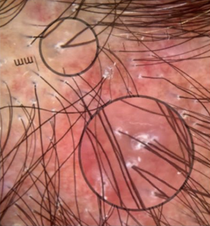 LPP and the eye.png