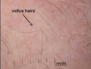 Peach Fuzz or Vellus Hair Beard: Everything You Need to Know