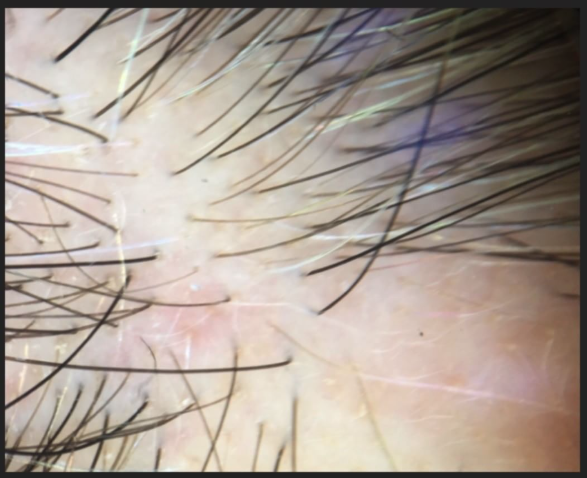 Frontal Fibrosing Alopecia The Early Stages Donovan Hair Clinic