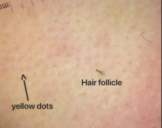 Alopecia Areata — Donovan Hair Clinic