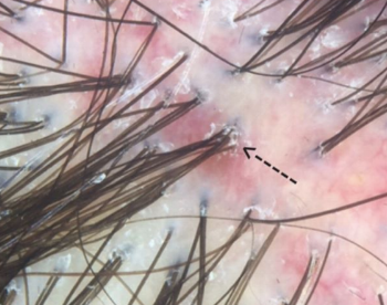 Fusion Follicles: Compound Follicles = More than 6 Hairs — Donovan Hair  Clinic