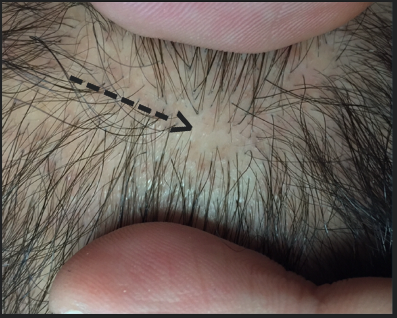 Androgenetic alopecia female deals