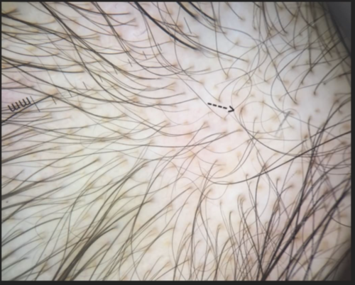 Yellow dots in Androgenetic Alopecia — Donovan Hair Clinic