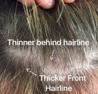 Female Pattern Hair Loss: Very Front Hairline Often Unaffected — Donovan  Hair Clinic