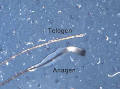 Examining Hair Samples: Anagen vs Telogen Hairs — Donovan Hair Clinic