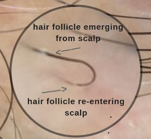 Scalp Folliculitis Causes Symptoms  Ayurvedic Remedies  Vedix