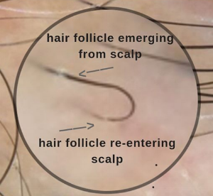 Dr Donovan S Hair Loss Articles 11 21 Donovan Hair Clinic