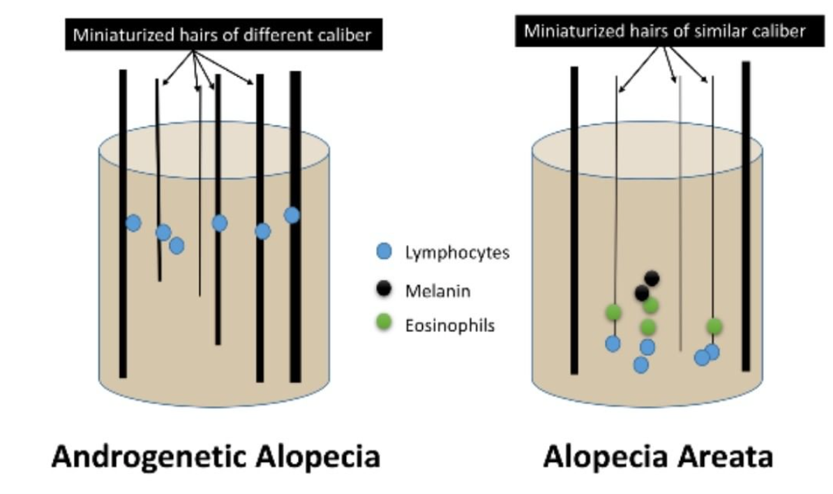 Miniaturization in Alopecia Areata vs Androgenetic Alopecia — Donovan Hair  Clinic