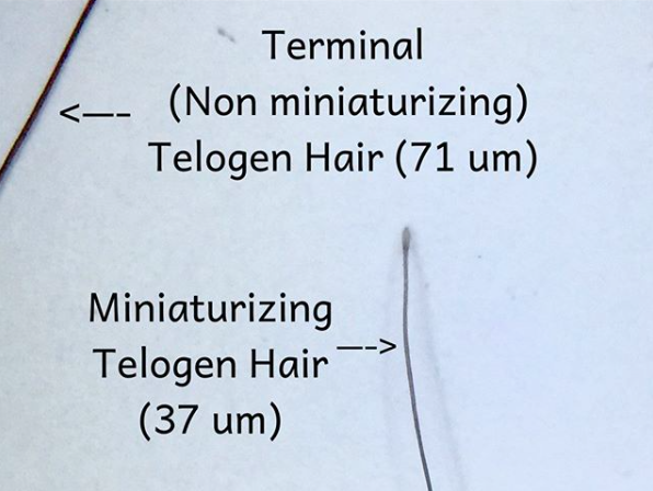 Telogen Hairs: Terminal, Miniaturizing and Vellus — Donovan Hair Clinic