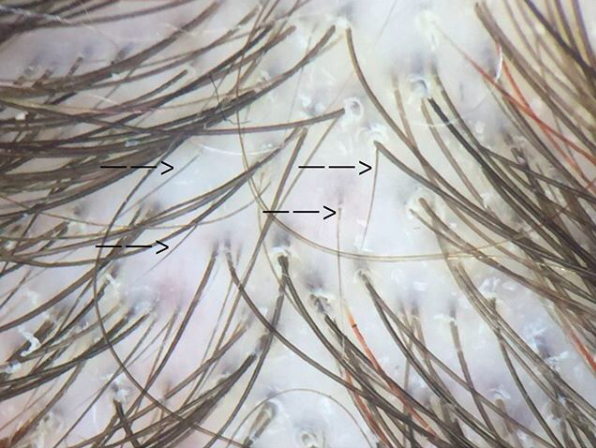 Numerous upright regrowing hairs in a patient with telogen effluvium.