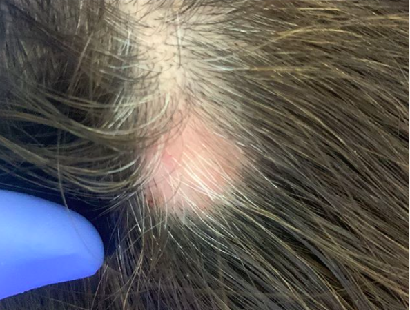 White Hairs in Alopecia Areata: Why do they occur? — Donovan Hair Clinic