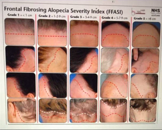 The Frontal Fibrosing Alopecia Severity Index FFASI Donovan Hair Clinic