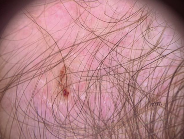 Scalp Psoriasis: Among the Many Causes of a Red Scaly Scalp — Donovan Hair  Clinic