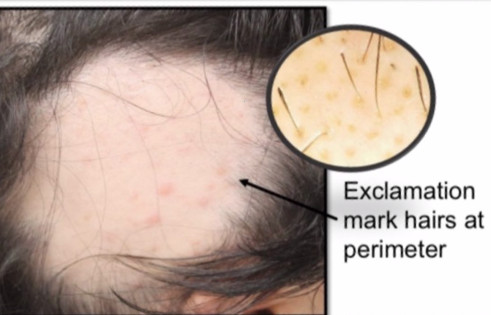 Exclamation Mark Hairs in Alopecia Areata Occur at Perimeter of Patch —  Donovan Hair Clinic