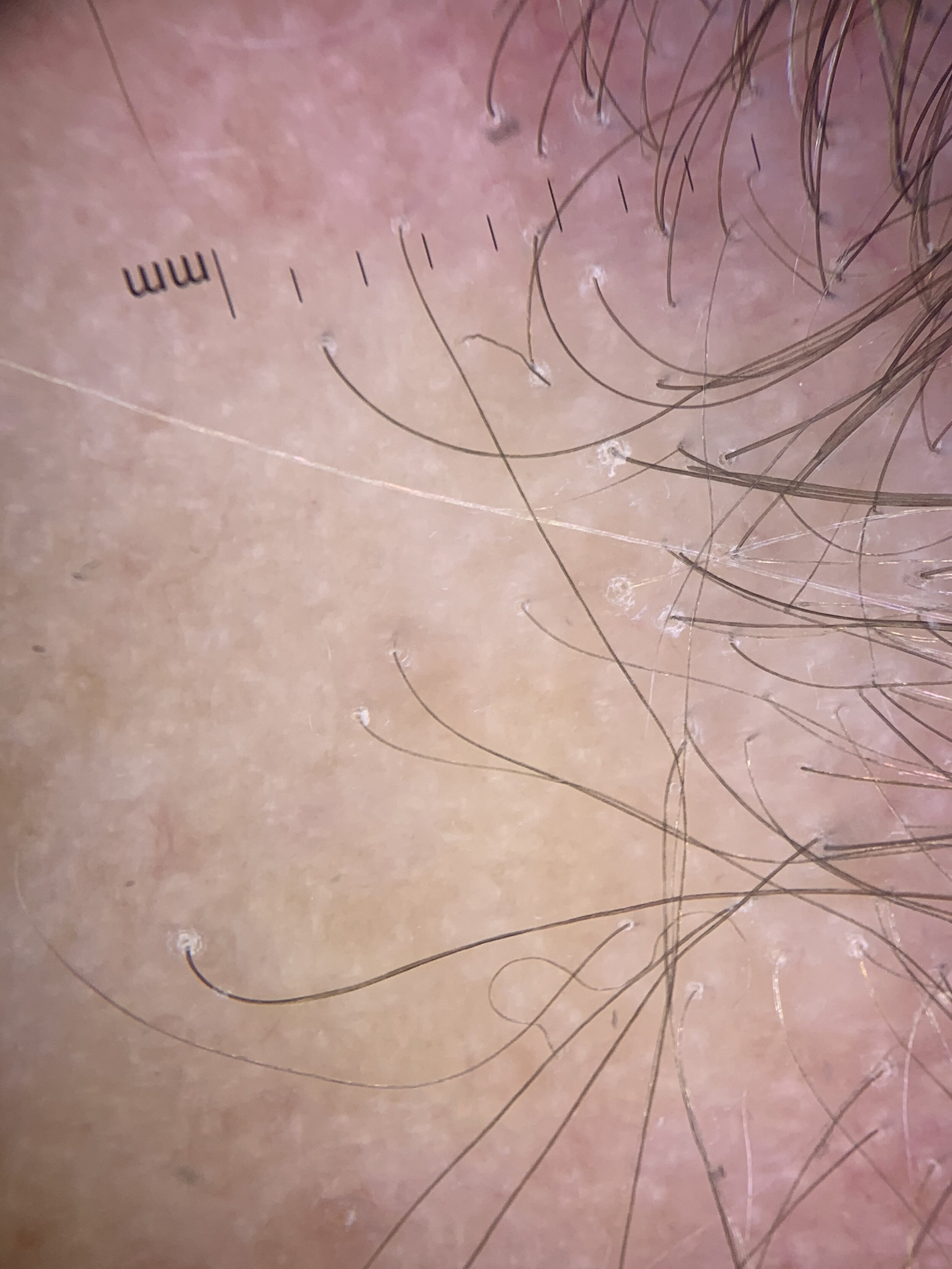 Single Hairs in Lichen Planopilaris: A Reflection of the Destructive  Process — Donovan Hair Clinic