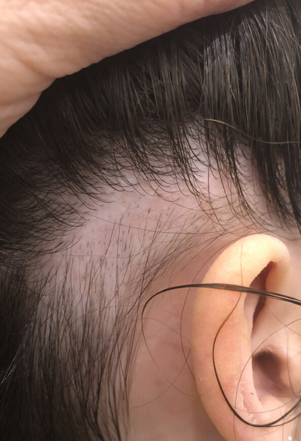 What is the diagnosis? Trichotillomania vs Alopecia Areata — Donovan Hair  Clinic
