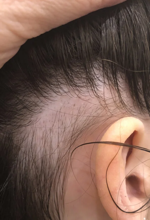 What is the diagnosis? Trichotillomania vs Alopecia Areata — Donovan