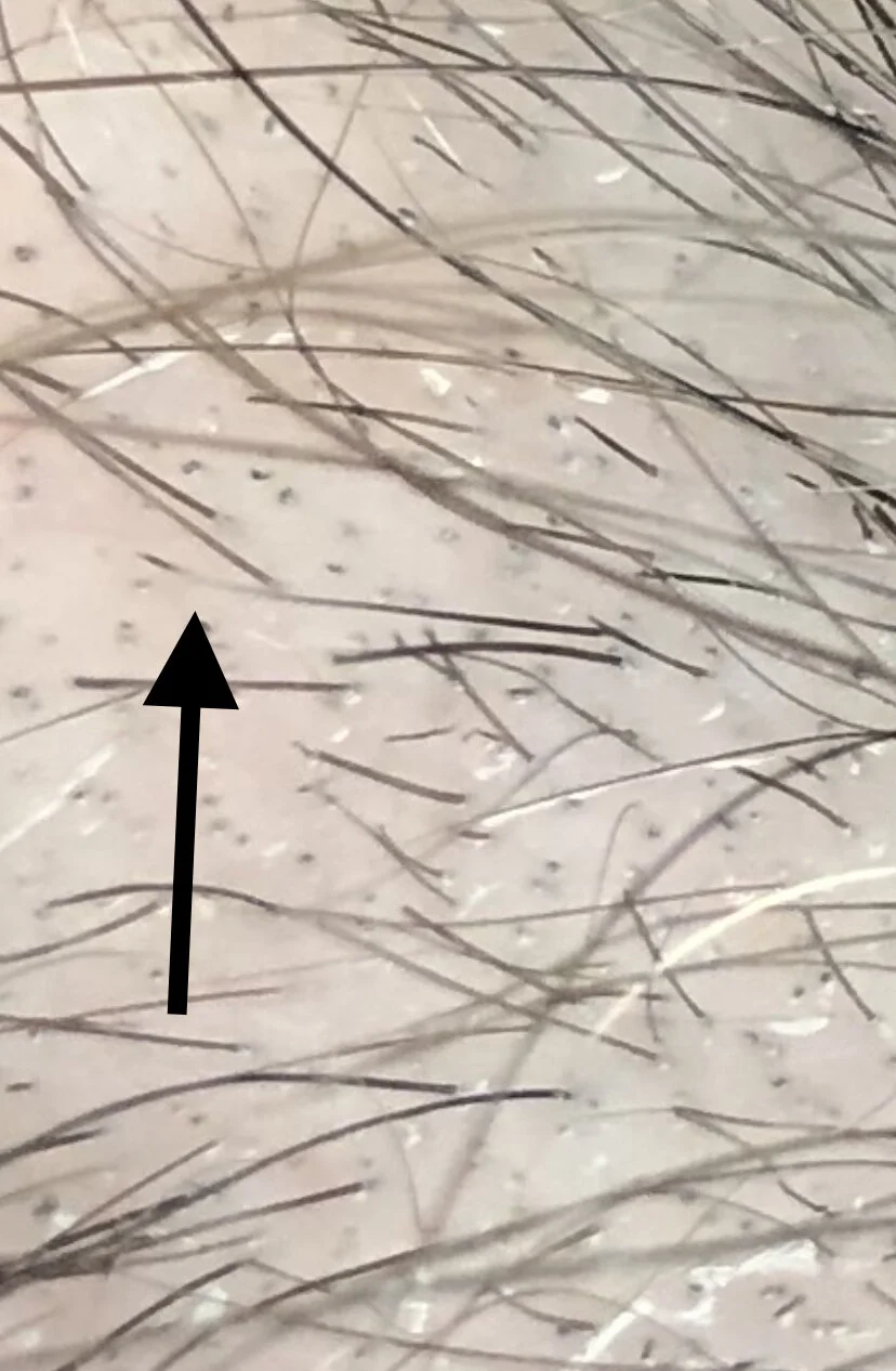 Trichotillomania — QUESTION OF THE WEEK — Donovan Hair Clinic