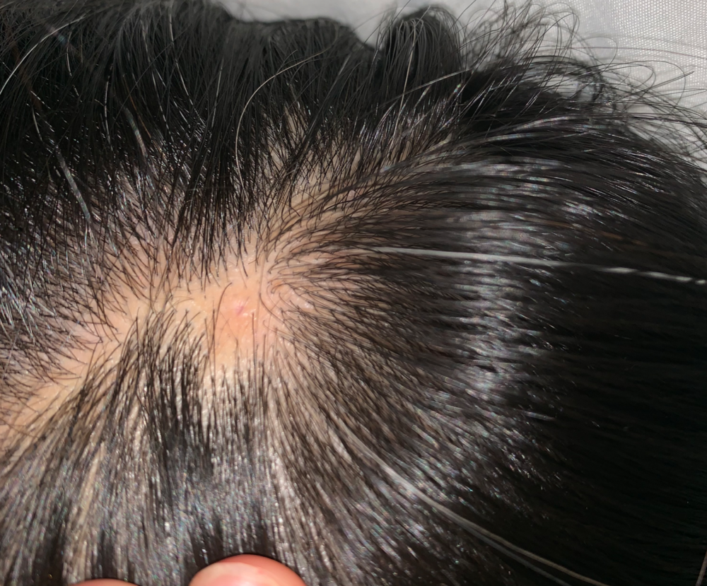 Localized Hair Loss on the Scalp — Donovan Hair Clinic