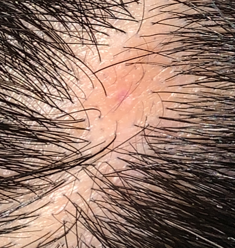 Trichotillomania — QUESTION OF THE WEEK — Donovan Hair Clinic