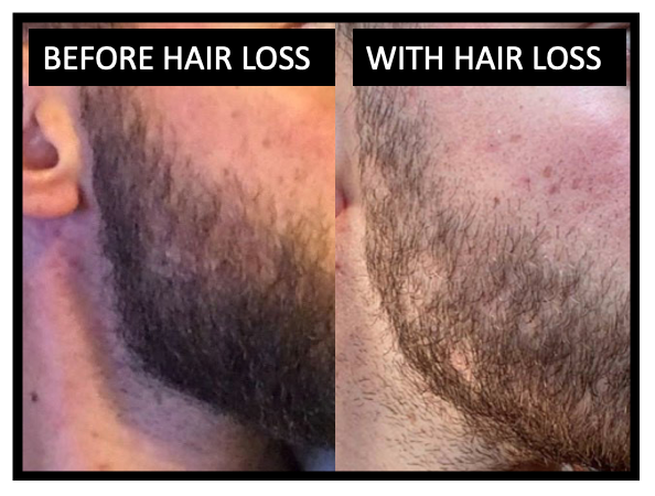 What is causing my beard, body and scalp hair loss? — Donovan Hair Clinic