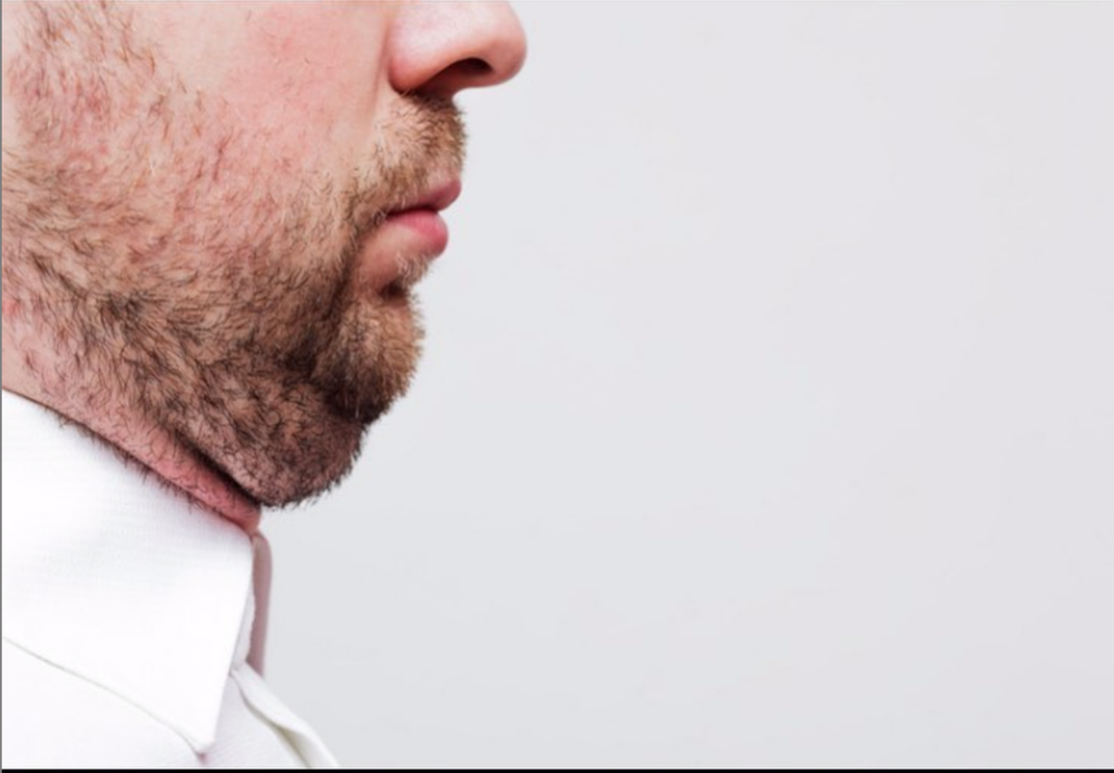 Chin/Beard Hair loss with Deoxycholic acid (Kybella/Belkyra) Injections in  Men — Donovan Hair Clinic