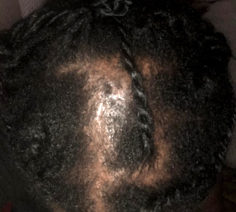 Do I have traction alopecia? Why isn't it growing back? — Donovan Hair  Clinic