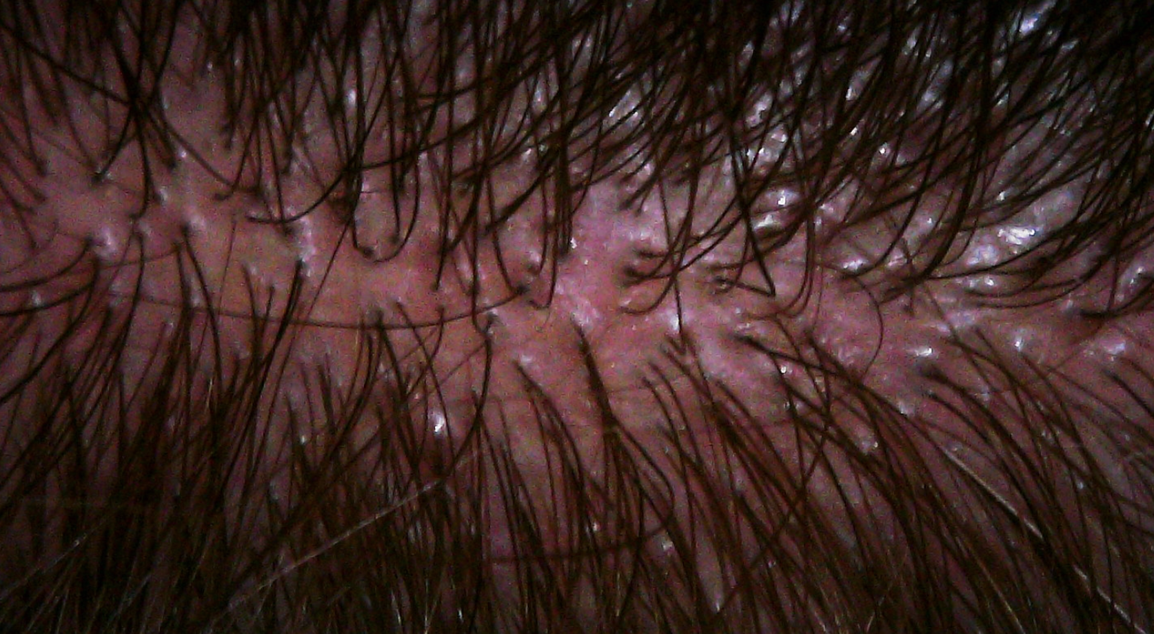 Seborrheic Dermatitis — QUESTION OF THE WEEK — Donovan Hair Clinic