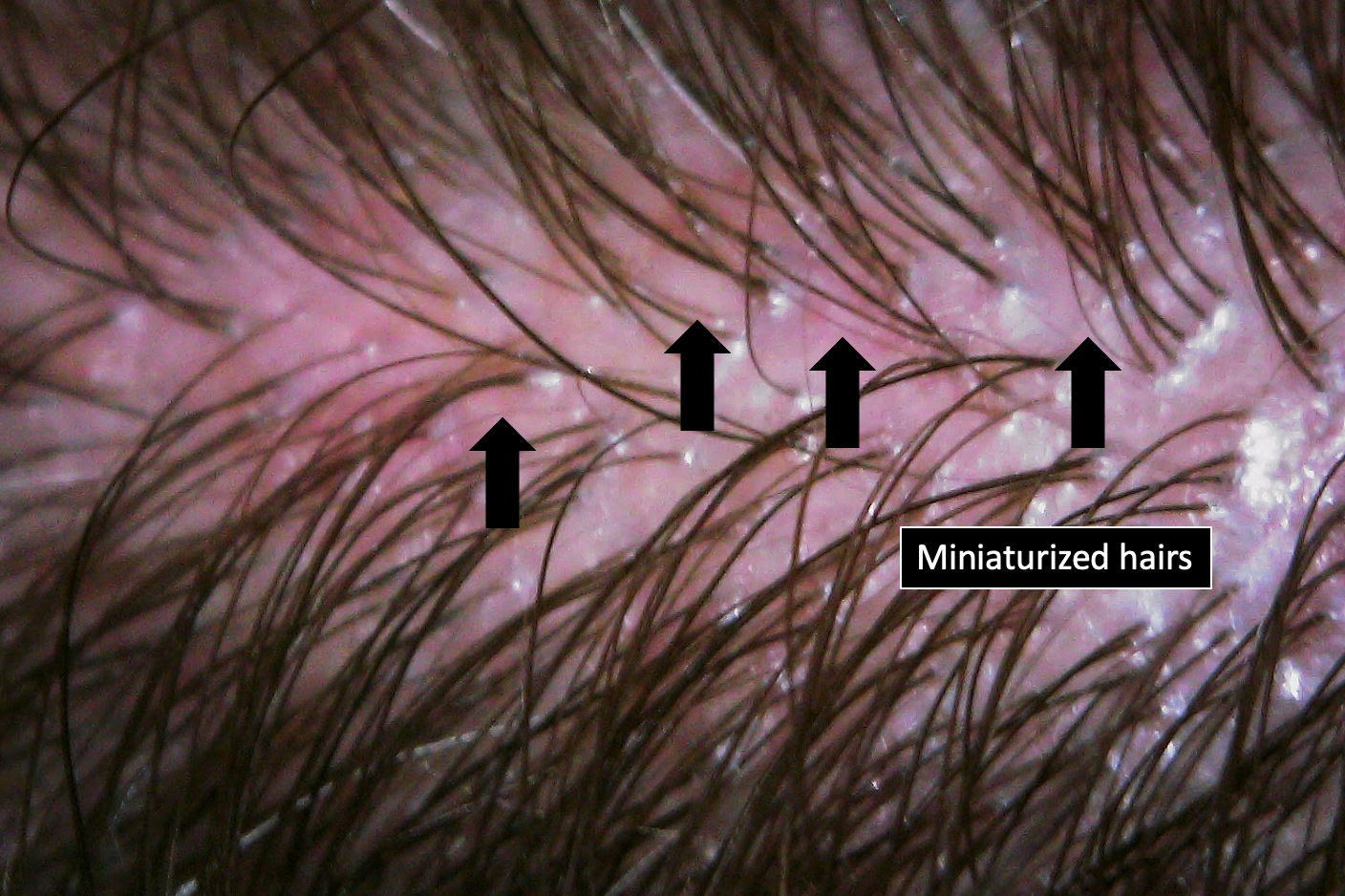 Sudden Loss of My Hair: What are possible reasons? — Donovan Hair Clinic