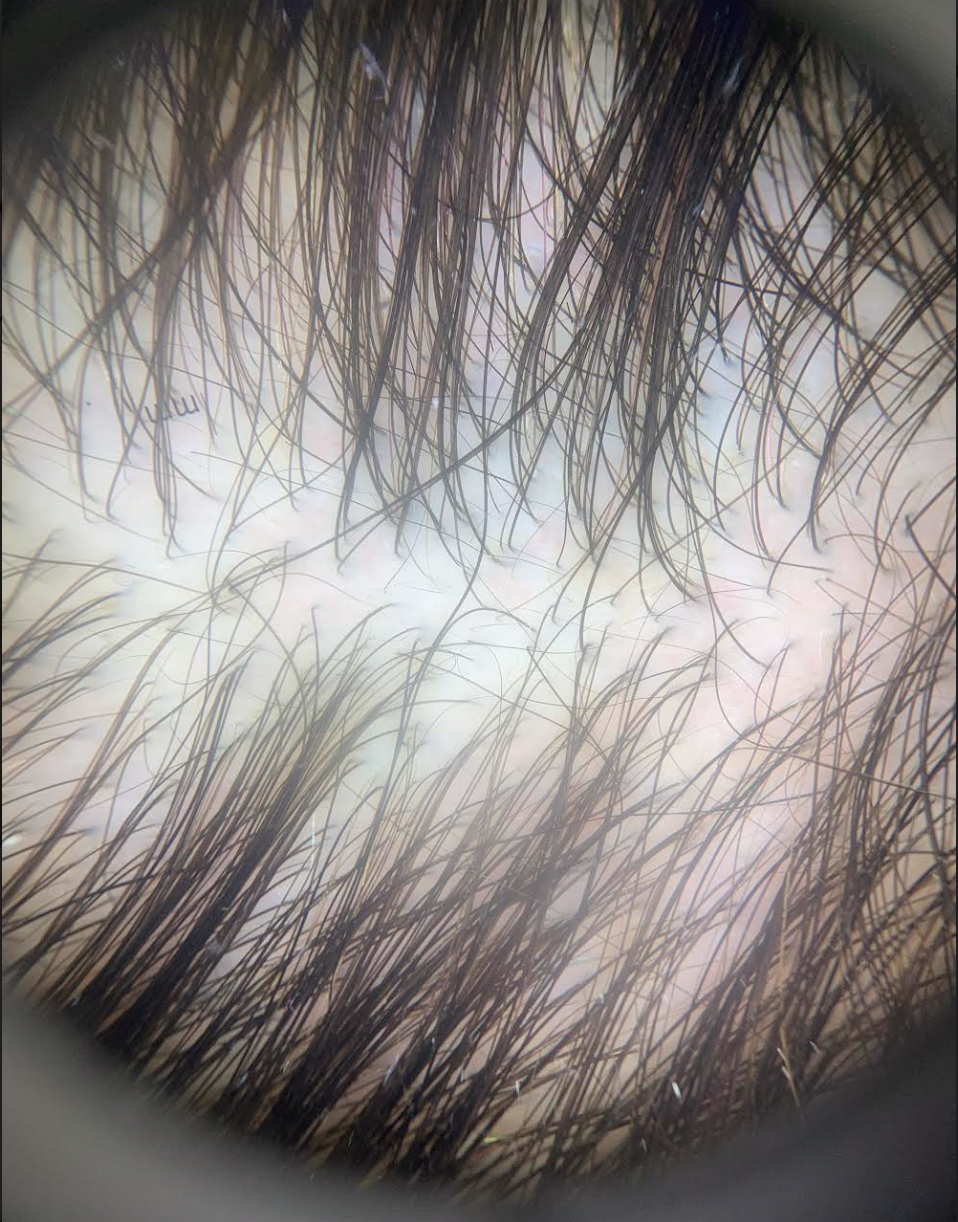 Adolescent onset Androgenetic Alopecia (AO-AGA): Key Lessons — Donovan ...