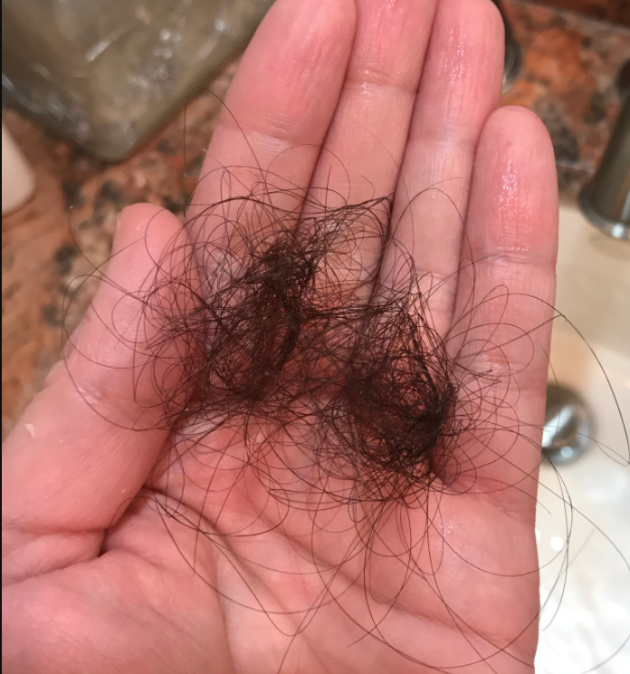 What Is a Normal Amount of Hair Loss to From Showering?