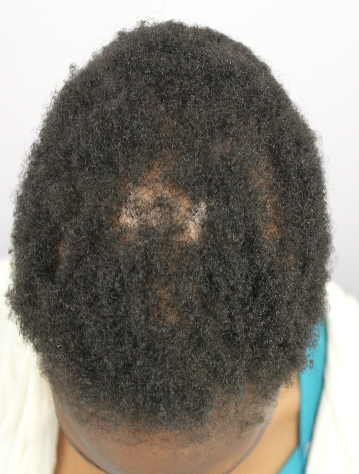 Excessive Hair Breakage Treatment - Mayra Skin and Aesthetic Clinic