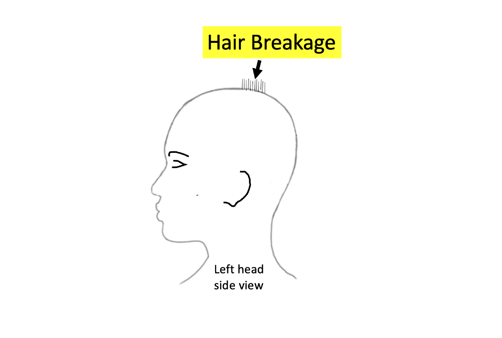 Hair Breakage and Hair Growth in Central Centrifugal Cicatricial Alopecia  (CCCA) — Donovan Hair Clinic