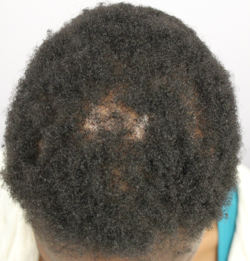 Central Centrifugal Cicatricial Alopecia (CCCA): Diagnosis and ...