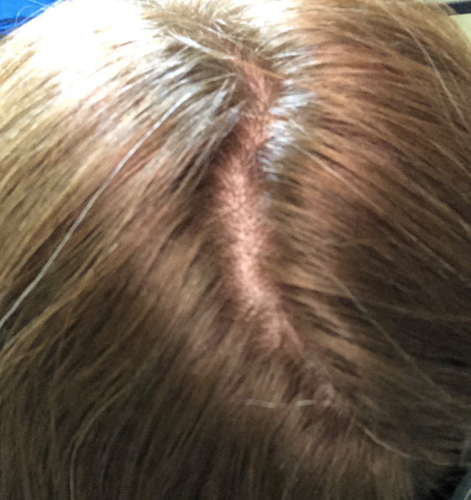 Do I just need patience or is my hair density not going to fully return