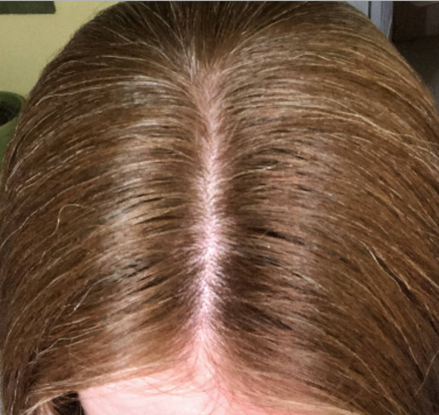 Telogen Effluvium — QUESTION OF THE WEEK — Donovan Hair Clinic
