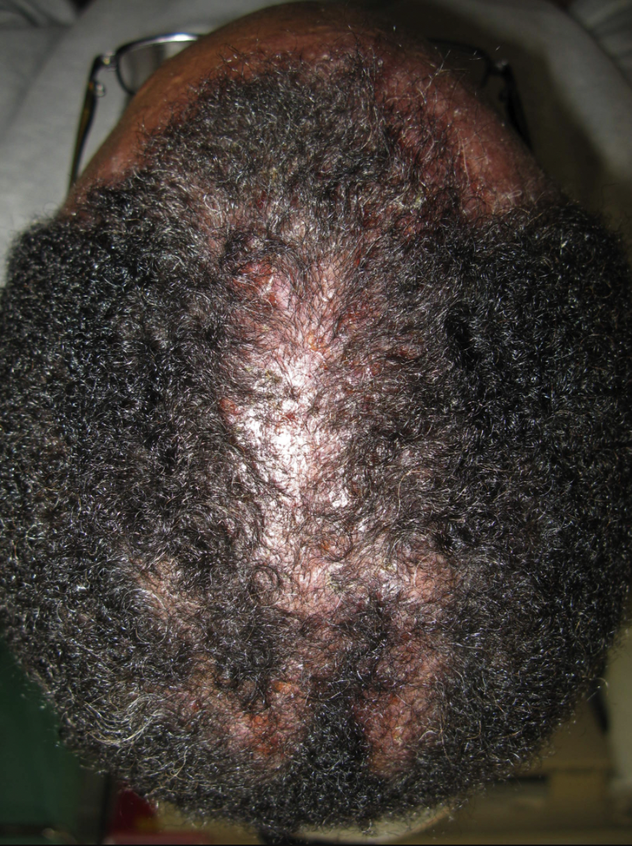 Scalp Sarcoidosis: Another One of the Great Mimickers — Donovan Hair Clinic
