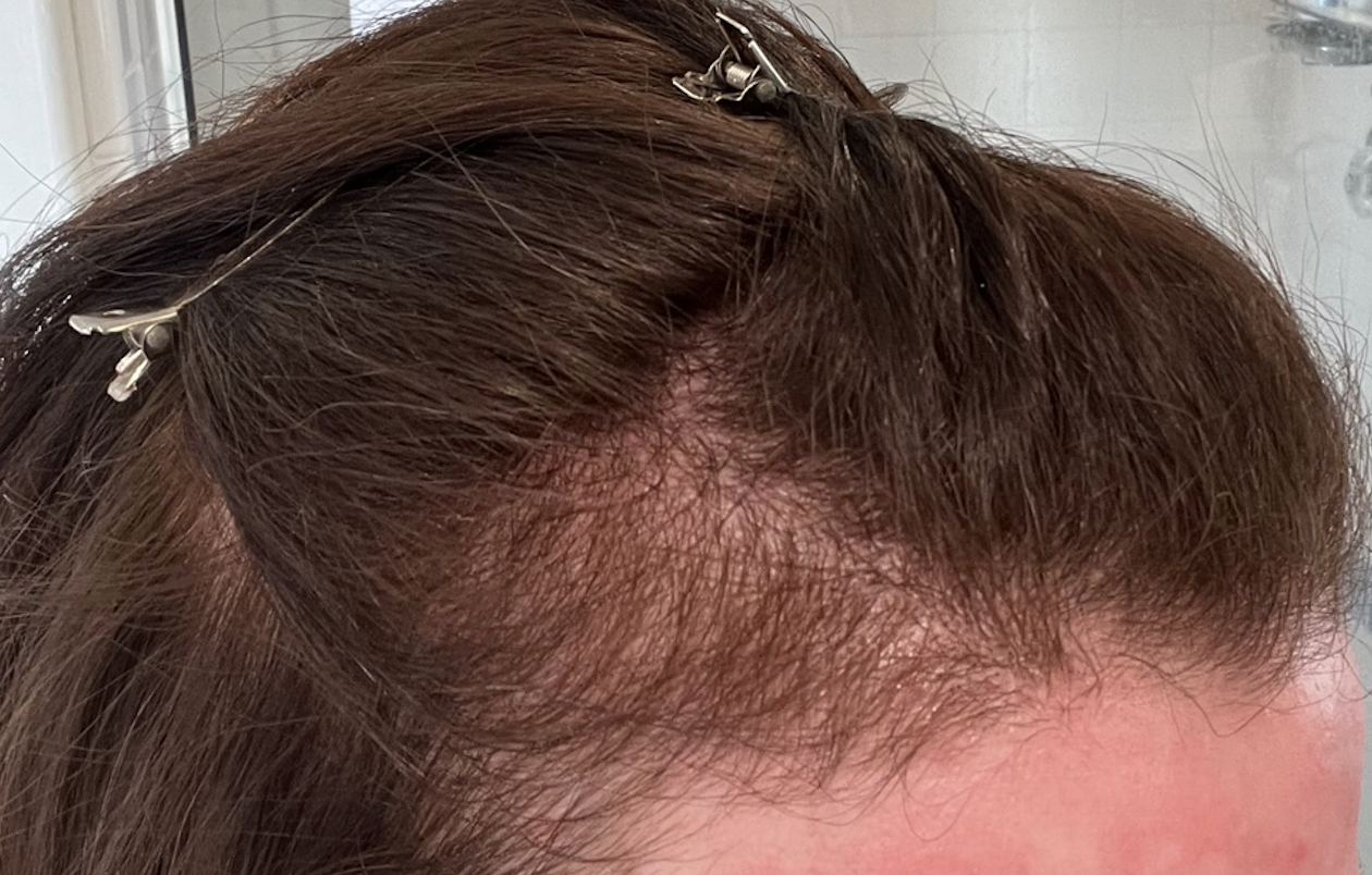Why am I shedding? — Donovan Hair Clinic
