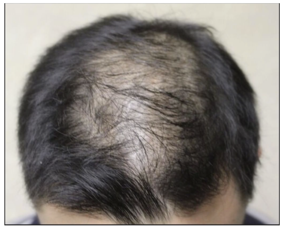 The Female Pattern of Male Pattern Balding: Lessons from 84 Patients —  Donovan Hair Clinic