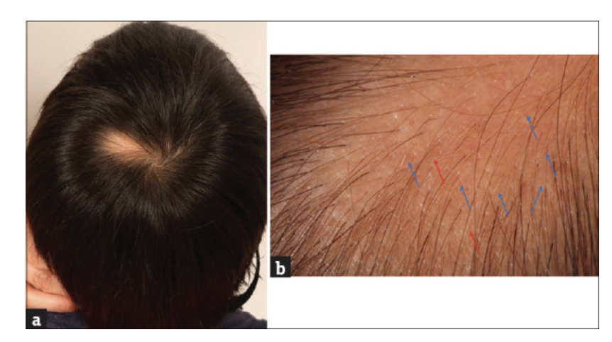 Atypical Location of Congenital Triangular Alopecia — Donovan Hair Clinic