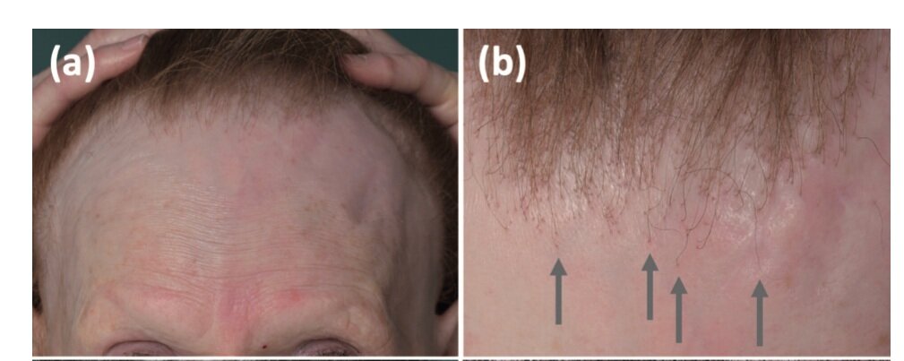 3 More Cases of Scarring Alopecia with Checkpoint Inhibitors — Donovan Hair  Clinic