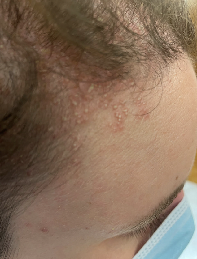 Acute Localized Exanthematous Pustulosis From Topical Minoxidil A new