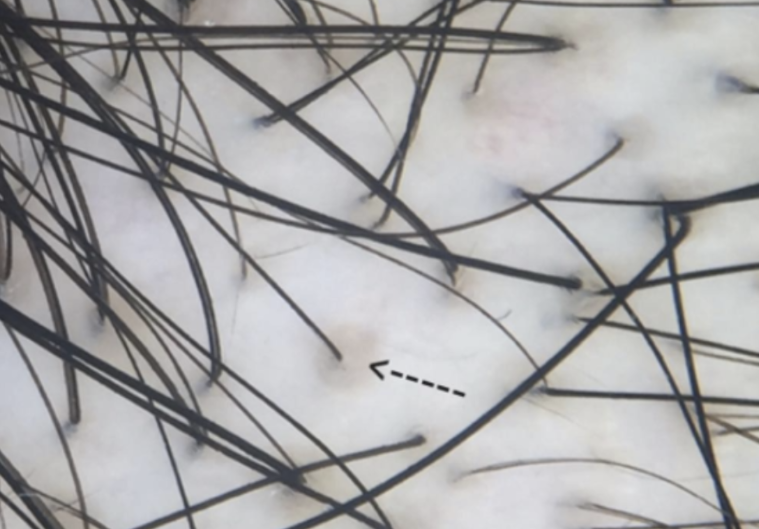 Peripilar Sign in AGA: Is it possible we have it all wrong? — Donovan Hair Clinic
