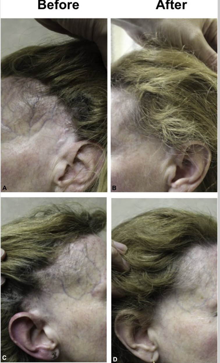 Frontal Hair Loss Products Treatments For Hair Loss At Temples For Men