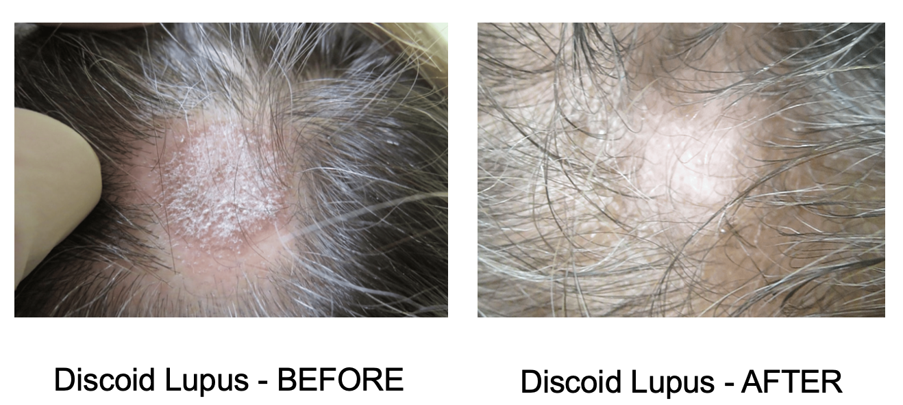 discoid-lupus-response-to-hydroxychloroquine-plaquenil-donovan