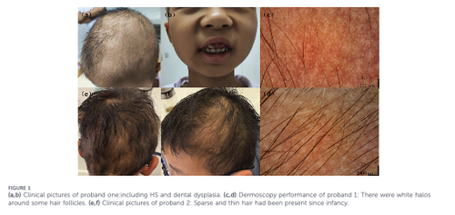 Lss Mutation Dr. Donovan's Hair Loss Articles (2011-2026) — Donovan Hair Clinic