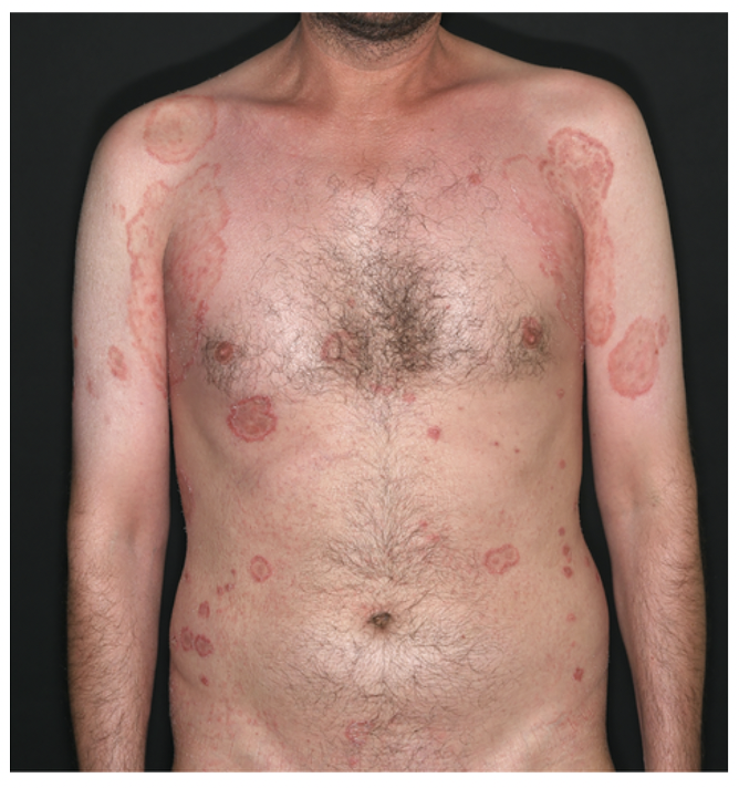 Rapid Onset of Tinea Capitis in Pediatric Patient Using Baricitinib. —  Donovan Hair Clinic