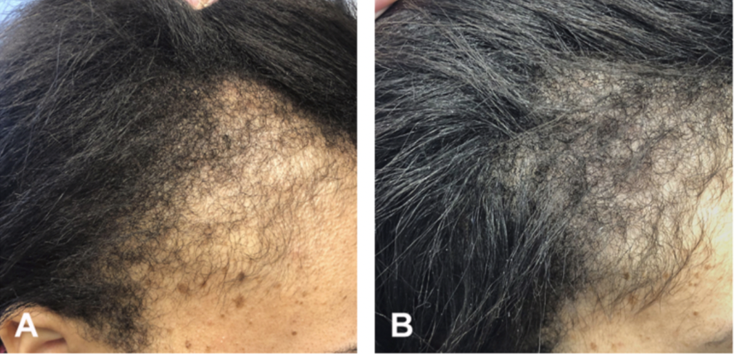 Oral Minoxidil Helps Traction Alopecia in Female Patients — Donovan