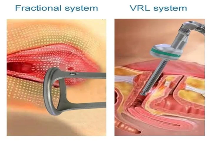 El Rejuvenecimiento Vaginal con Láser