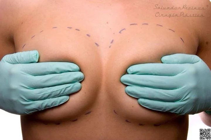 Las 20 dudas más usuales del Aumento Mamario!